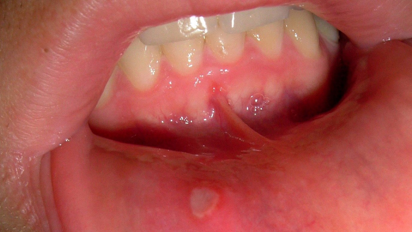 tiny-bumps-on-mouth-roof-red-spots-on-roof-of-mouth-causes-and-other